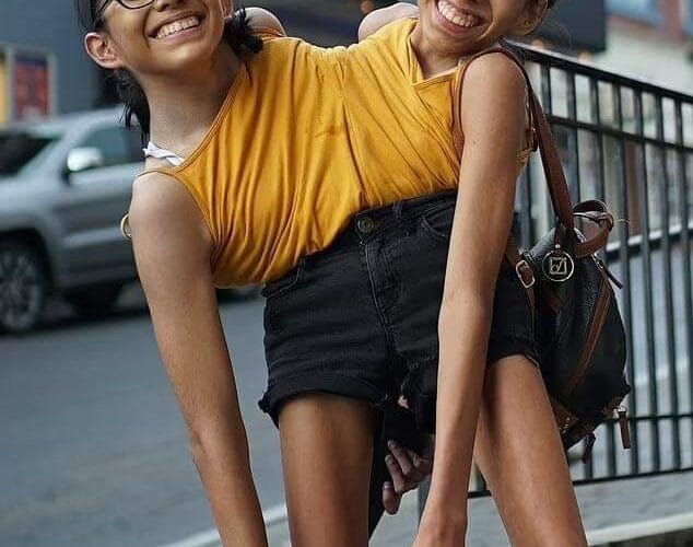 22-year-old Conjoined Twin Sisters Open Up About Their Dating Lives