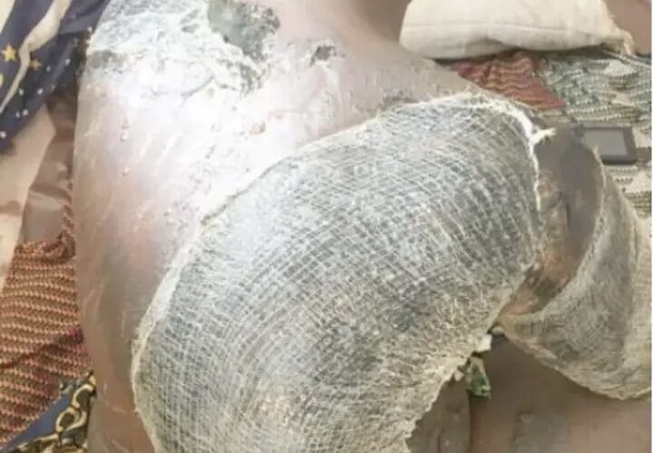 Drama As Woman Bathes Co-Wife With Hot Water