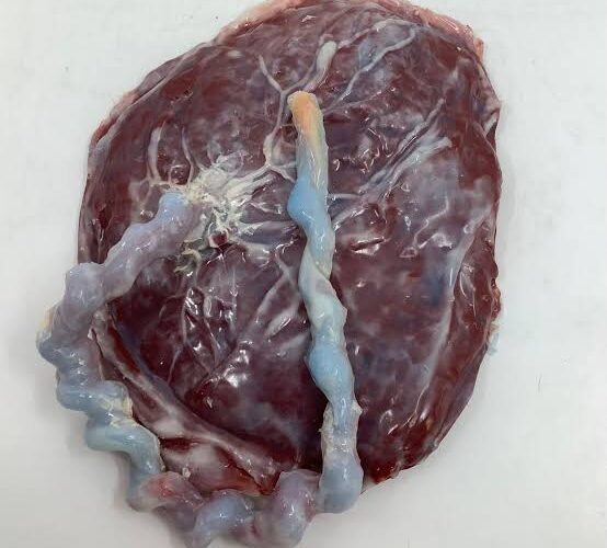 Doctor, Nurses Detained Over Missing Placenta, Umbilical Cord