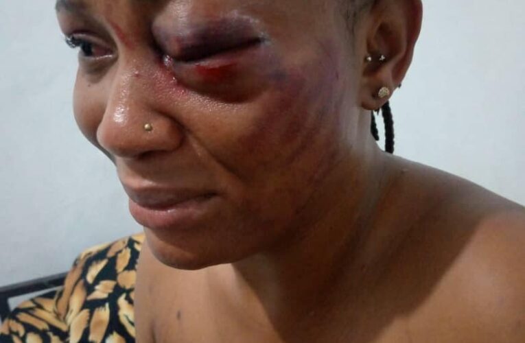 15 Years In Abusive Relationship With A Beast Has Cost Me My Left Eye (pics)