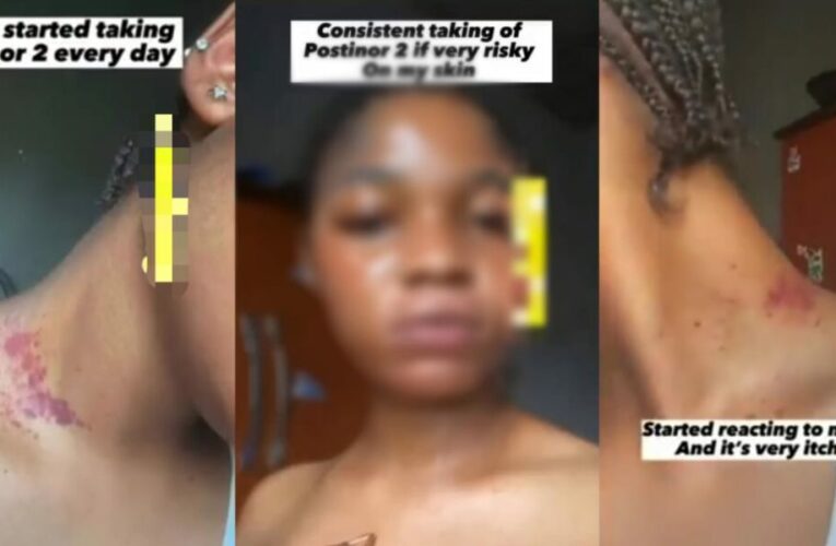 Lady Shares Shocking Skin Effects After Taking Postinor-2 Daily