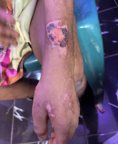 Girl Badly Beaten, Burnt And Starved By Her Guardian Is Rescued In Lagos(photos)