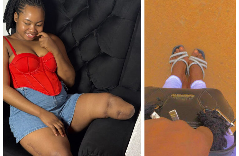 “I Wish I Stayed Home That Day” — Nigerian Woman Who Lost Both Legs In Accident Shares Regrets